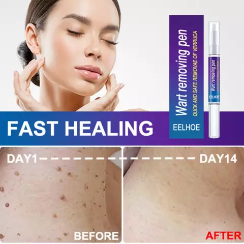 Wart removing pen